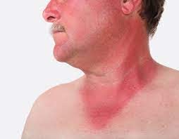 Sunburn dangers