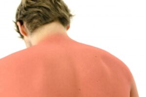 best color shirt to prevent sunburn