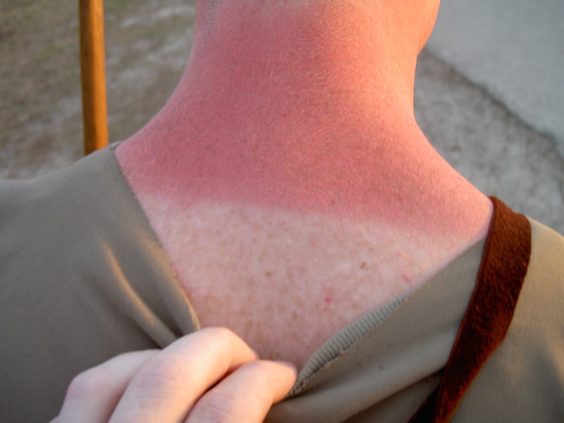 Man with a sunburn on his neck showing complete sun block on covered skin, 