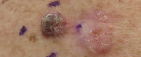 Example of squamous cell carcinoma for you to compare your questional areas to