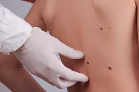 Moles are another place skin cancer can show up.